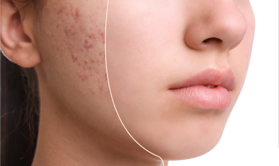 Acné
Le traitement au Laser AC Dual cible les bactéries responsables de l’acné et réduit l’inflammation de la peau.
En savoir plus